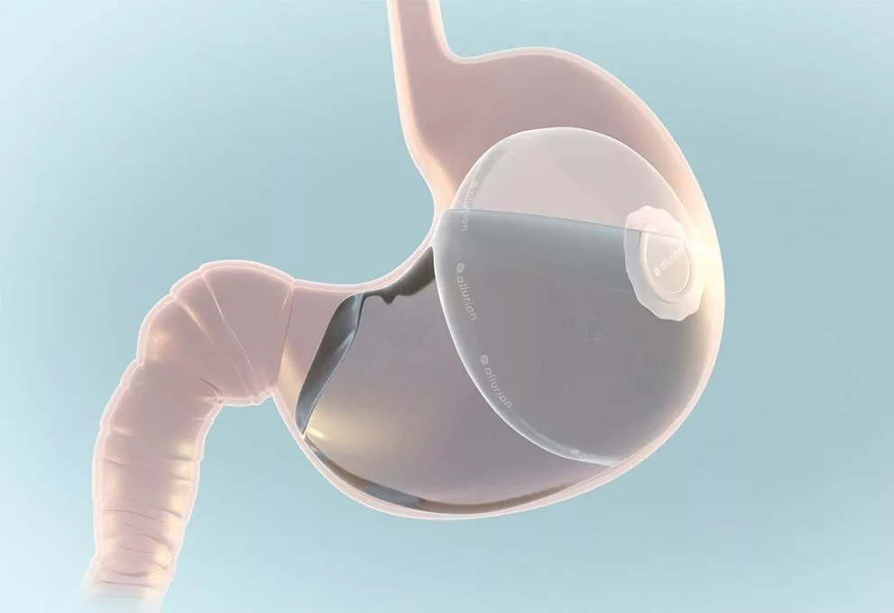 Swallowable Gastric Balloon